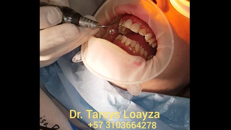 Sonrisa Perfecta Dental - Dra. Tarsys Loayza Roys