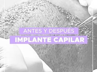 Implantes de cabello - Dra. Lady Mora y Dr. Juan Felipe Acosta