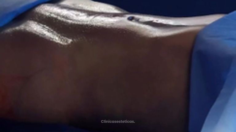 Lipoescultura HD - Clinica Vivir