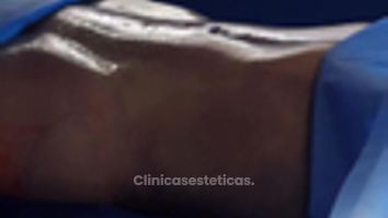 Lipoescultura HD - Clinica Vivir