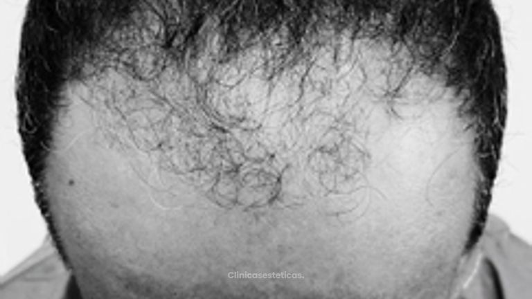 Alopecia  - Innovart Medical IPS