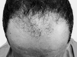 Alopecia  - Innovart Medical IPS