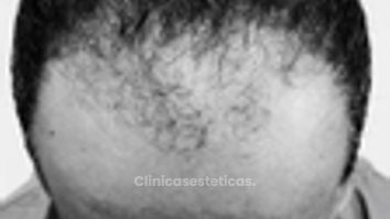 Alopecia  - Innovart Medical IPS