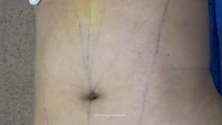 Lipólisis HD - Dr. Tobias Gutiérrez