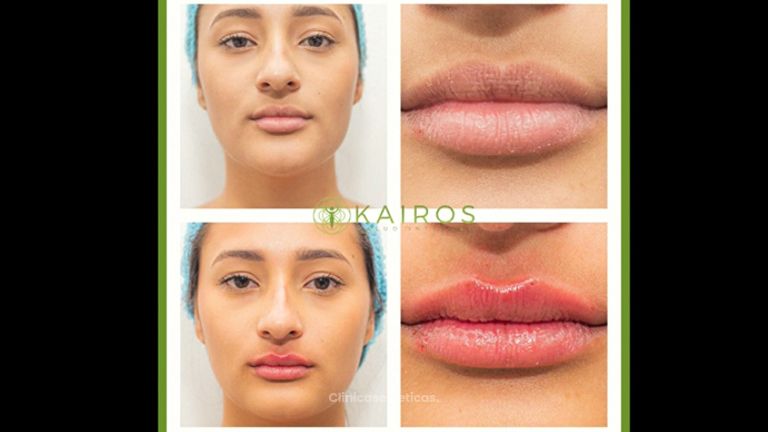 Aumento de labios - Kairos Salud Integral