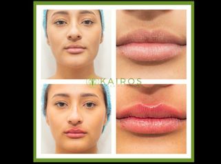 Aumento de labios - Kairos Salud Integral