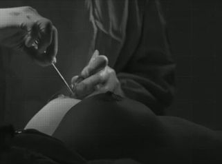 Mamoplastia de Aumento