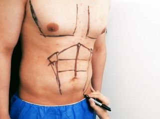 Lipoescultura masculina