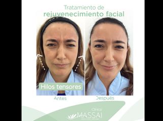 Rejuvenecimiento facial - Massai Clínica