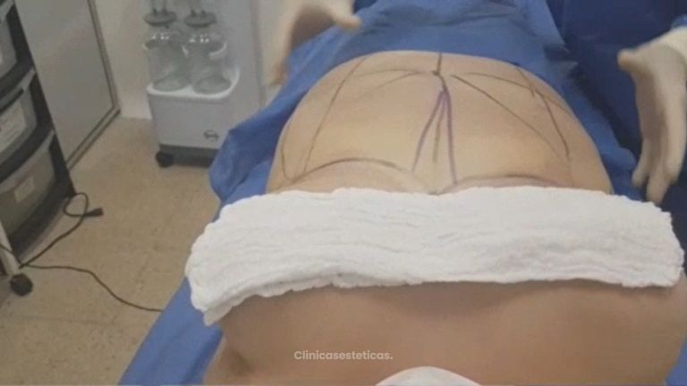 Abdominoplastia, Cirugía de Abdomen - Doctor Martínez Gutiérrez
