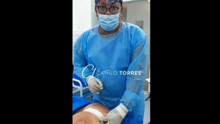 Gluteoplastia - Dr. Camilo Rafael Torres Rodríguez