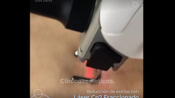 Eliminar estrías - Innova Laser Center