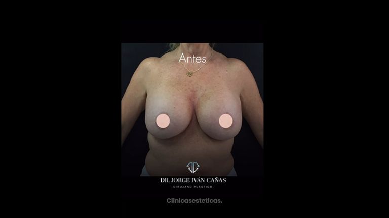Levantamiento de senos - Dr. Jorge Iván Cañas Palacio