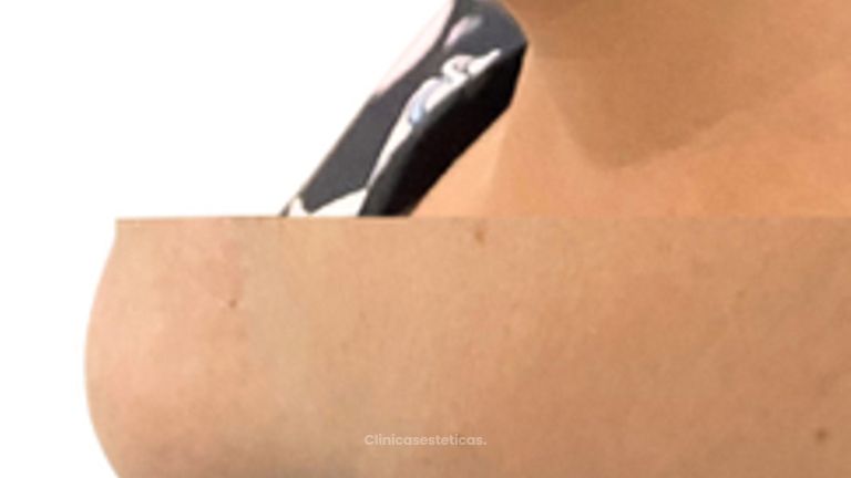 Mentoplastia - Doctora Alexandra Mora
