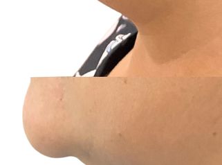 Mentoplastia - Doctora Alexandra Mora