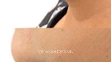 Mentoplastia - Doctora Alexandra Mora