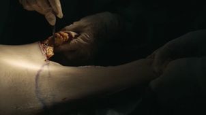 Información abdominoplastia