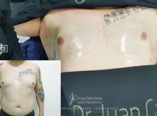 Ginecomastia - Dr. Juan Carlos Herrera P.