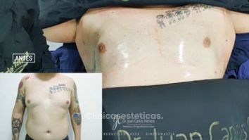 Ginecomastia - Dr. Juan Carlos Herrera P.