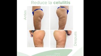 Celulitis - Massai Clínica