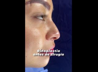Rinoplastia - Dr. Julio César Acosta
