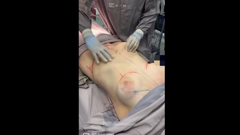 Lipoescultura - Dr Fulvio Alexander Correa