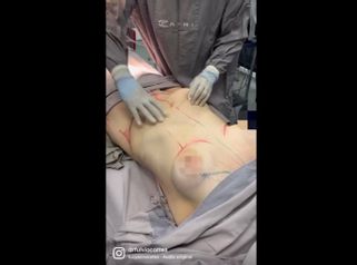 Lipoescultura - Dr Fulvio Alexander Correa