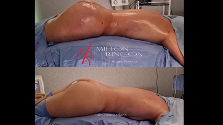 Gluteoplastia - Dr. Milton Rincón Carranza