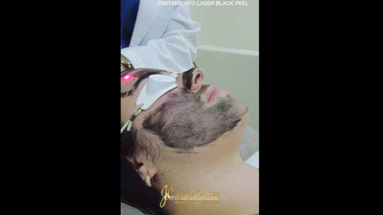 Tratamiento Laser Black Peel - Dr. Juan Carlos Herrera P.