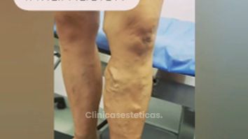 antes y despues de varices. 