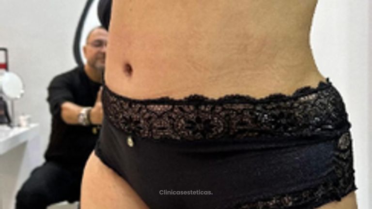 Abdominoplastia - Dr. Reinel Mesa