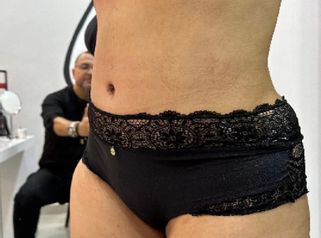 Abdominoplastia - Dr. Reinel Mesa