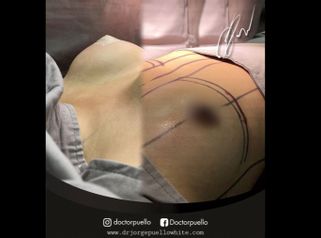 Mamoplastia de aumento - Dr Jorge Puello White