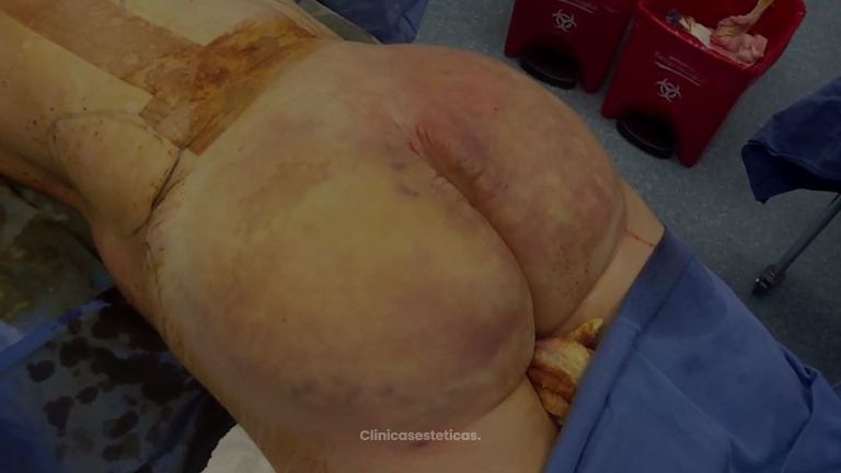 Dr. Juan Carlos Castilla Zamorano -Retirar biopolimeros