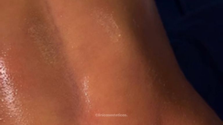 Lipoescultura HD - Clinica Vivir