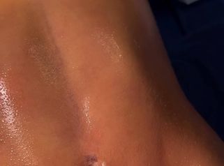 Lipoescultura HD - Clinica Vivir