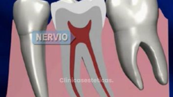 Endodoncia