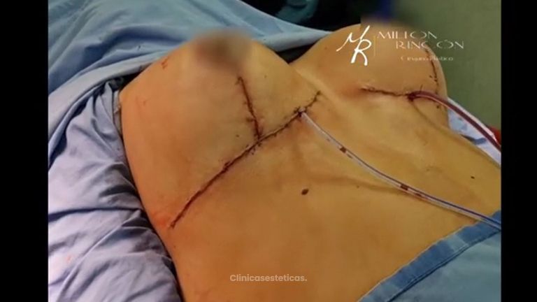 Mamoplastia de reducción - Dr. Milton Rincón Carranza