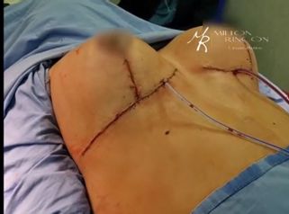 Mamoplastia de reducción - Dr. Milton Rincón Carranza