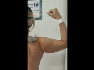 Liposucción de brazos - Dra. Paola León