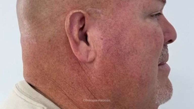 Endolif Facial - Dra. Yulieth Figueroa Peñaranda