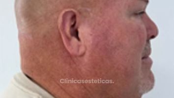 Endolif Facial - Dra. Yulieth Figueroa Peñaranda