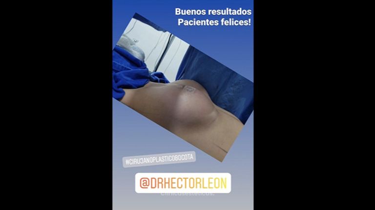 Mamoplastia de aumento  - Dr. Héctor Guillermo León Higuera