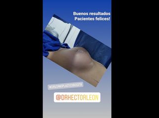 Mamoplastia de aumento  - Dr. Héctor Guillermo León Higuera