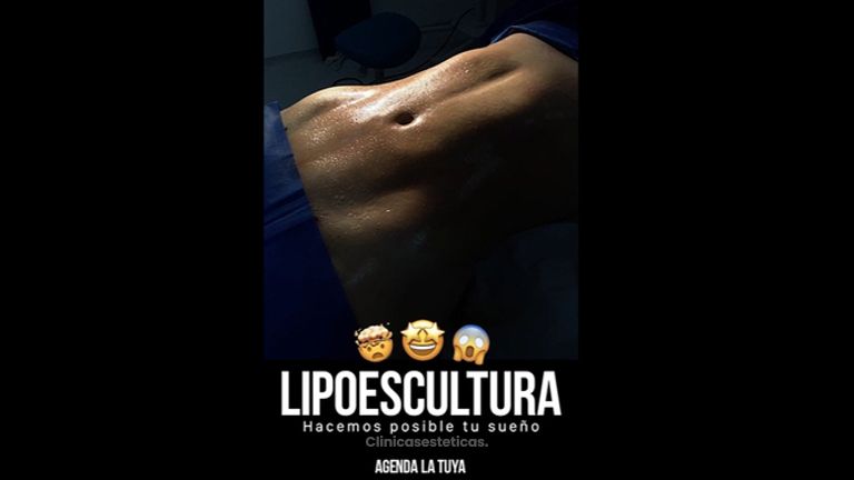 Lipoescultura - Dr. Luis Fernando Reyes