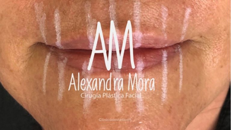 Relleno de labios - Doctora Alexandra Mora