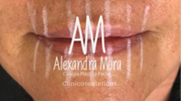 Relleno de labios - Doctora Alexandra Mora