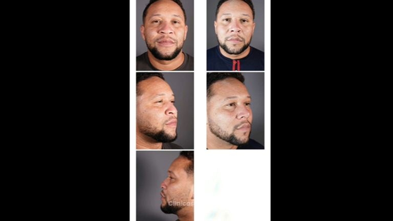 Rinoplastia - Dr Fulvio Alexander Correa