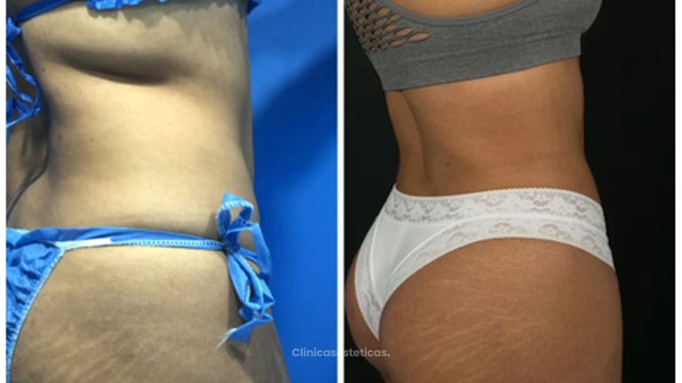 Liposucción - Dr. Zamir Páez