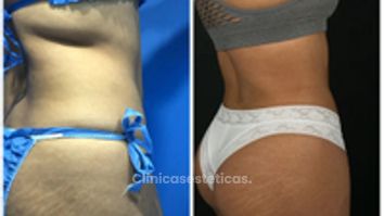 Liposucción - Dr. Zamir Páez